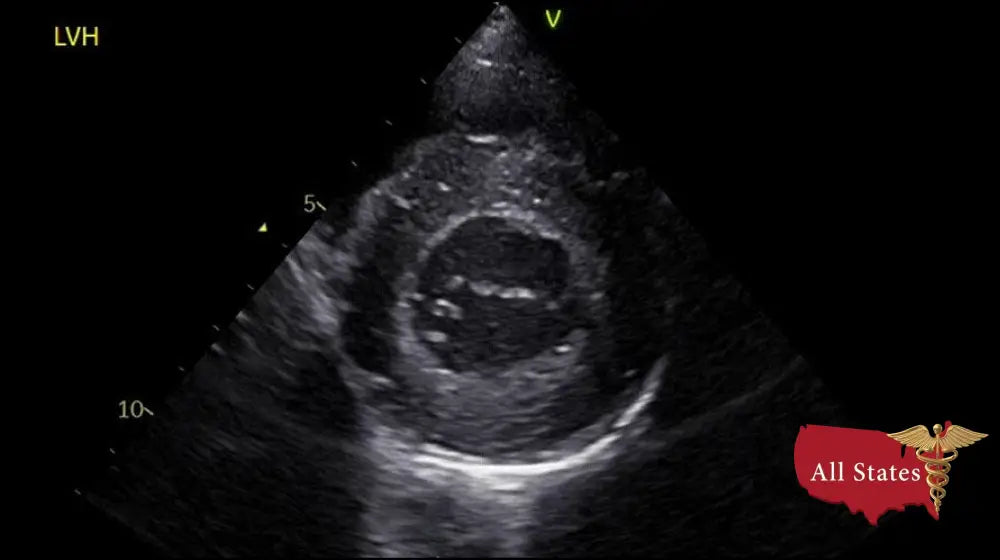 GE VIVID IQ Refurbished with 2 Probes